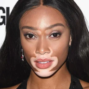 Photo star :  Winnie Harlow