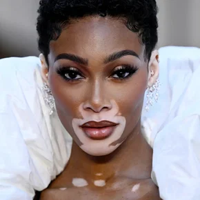 Photo star :  Winnie Harlow