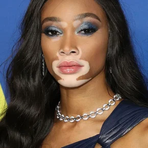 Photo star :  Winnie Harlow